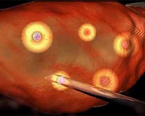 合肥代怀花费,宫腔黏连在合肥做试管要多少钱，合肥宫腔黏连做试管的医院及